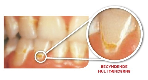 BEGYNDENDE HUL I TÆNDERNE