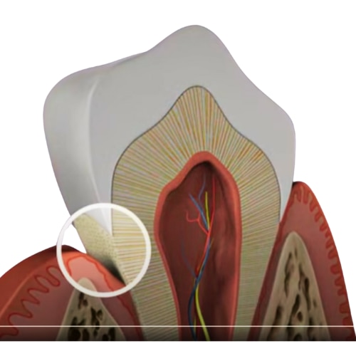Tværsnit af tand med fokus på blottet tandhals og dentinkanaler, der viser nerver og emalje i tandkødet