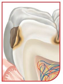 Hvad forårsager huller i tænderne