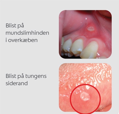 Blist på mundslimhinden i overkæben